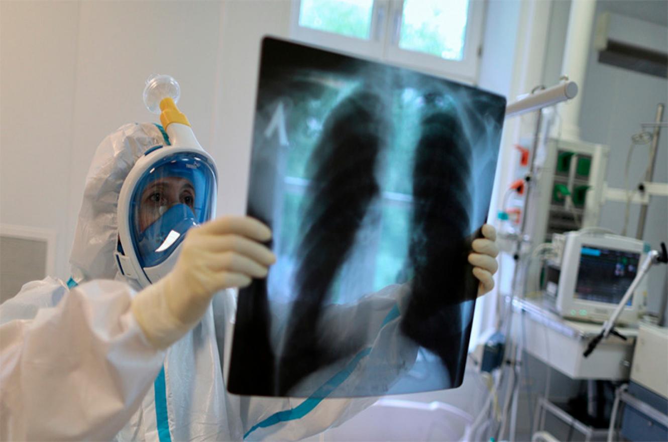 coronavirus radiografías